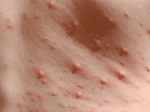 水痘早期症状图片 水痘早期和晚期症状介绍